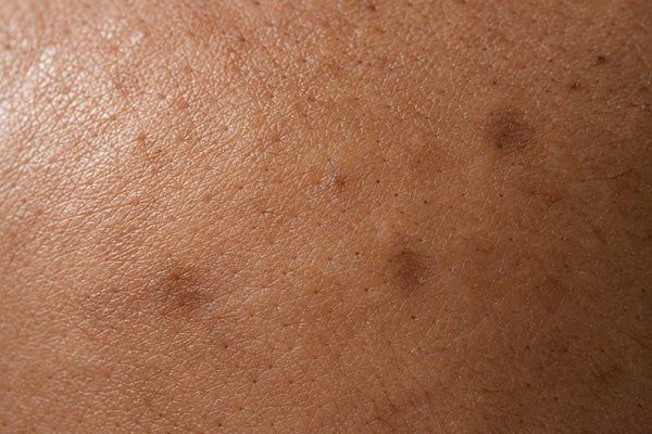Dark Marks After Pimples: Why They Remain After Acne Clears