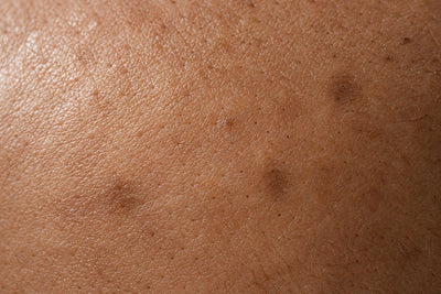 Dark Marks After Pimples: Why They Remain After Acne Clears