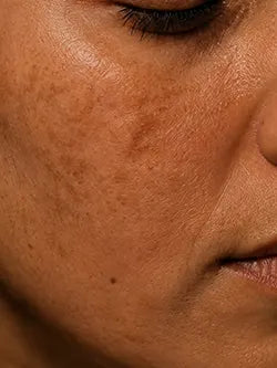 Pigmented/ Tanned