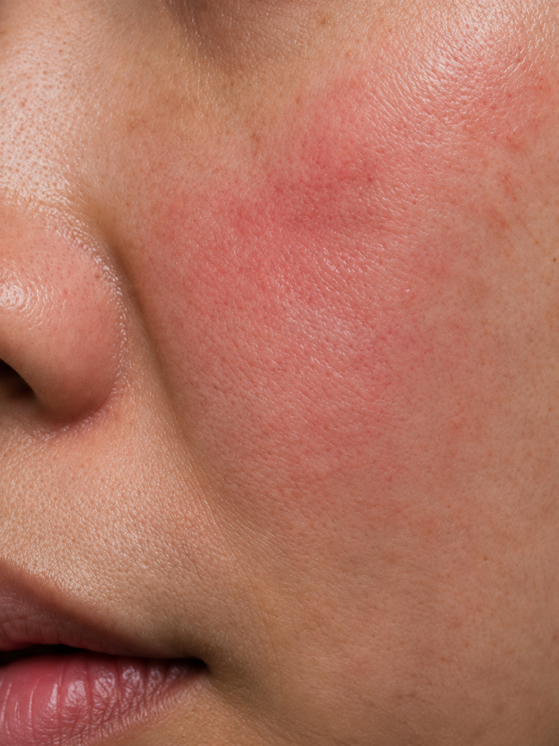 Redness/ Sensitive